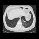 Tree in bud pattern, infectious bronchiolitis: CT - Computed tomography